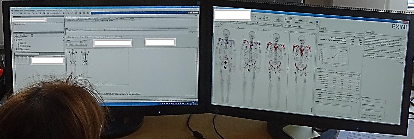 Syftet med forskningsprojekt om BSI hos patienter med prostatacancer (PC) Är BSI en bildbiomarkör