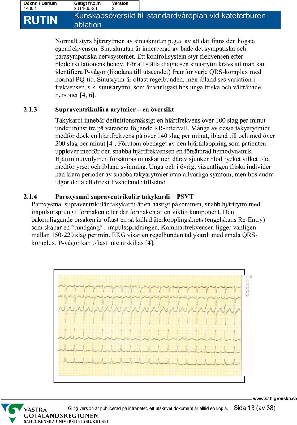 För att ställa diagnosen sinusrytm krävs att man kan identifiera P-vågor (likadana till utseendet) framför varje QRS-komplex med normal PQ-tid.