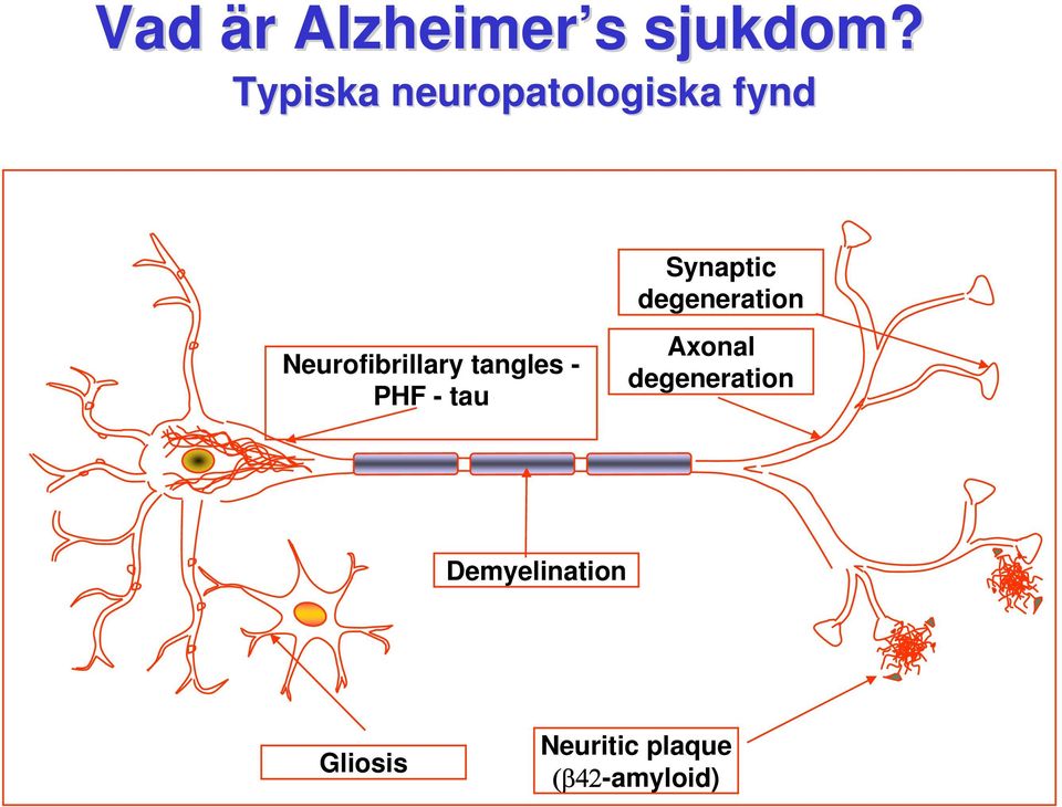 tangles - PHF - tau Synaptic degeneration