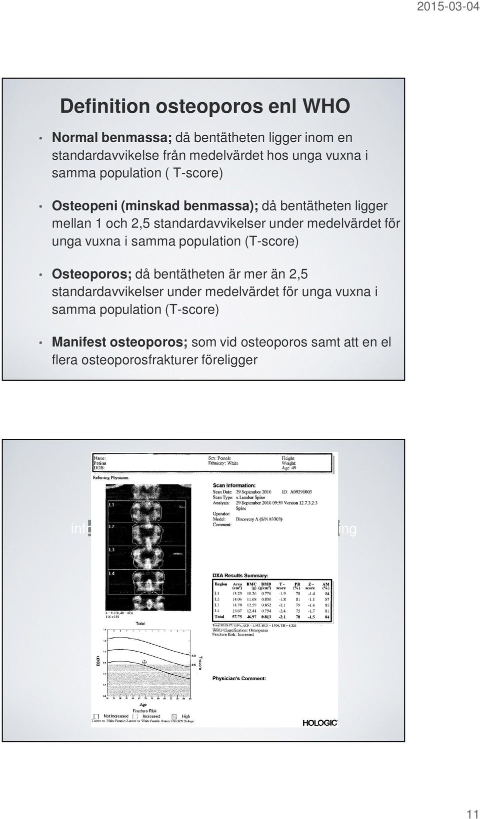 vuxna i samma population (T-score) Osteoporos; då bentätheten är mer än 2,5 standardavvikelser under medelvärdet för unga vuxna i samma