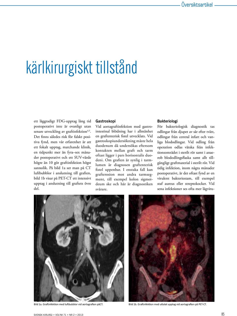 graftinfektion högst sannolik. På bild 1a ser man på CT luftbubblor i anslutning till graften, bild 1b visar på PET-CT ett intensivt upptag i anslutning till graftets övre del.
