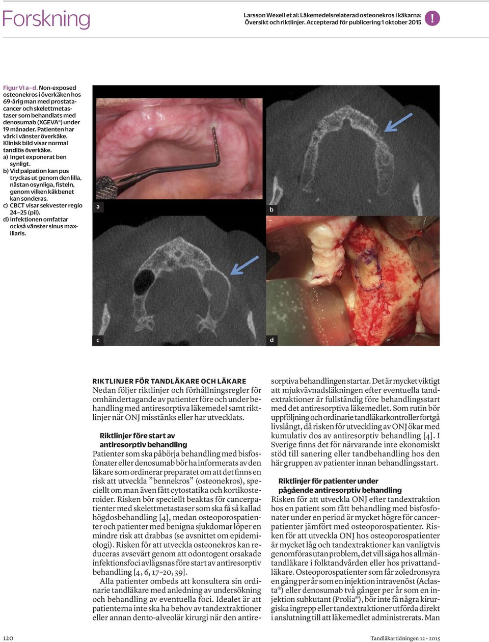 Klinisk bild visar normal tandlös överkäke. a) Inget exponerat ben synligt. b) Vid palpation kan pus tryckas ut genom den lilla, nästan osynliga, fisteln, genom vilken käkbenet kan sonderas.