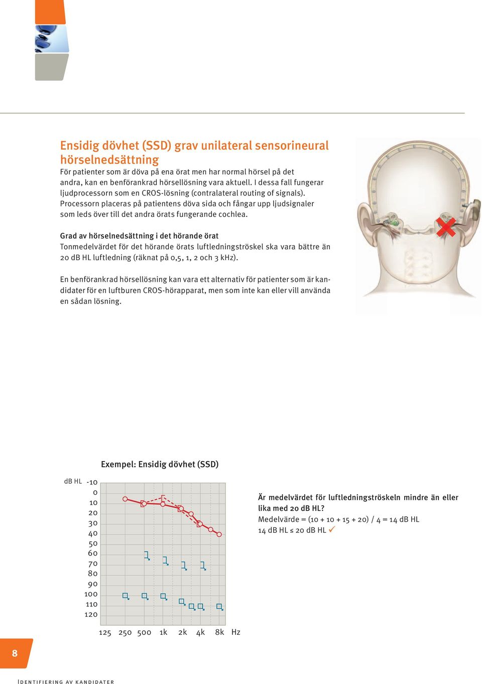 Processorn placeras på patientens döva sida och fångar upp ljudsignaler som leds över till det andra örats fungerande cochlea.