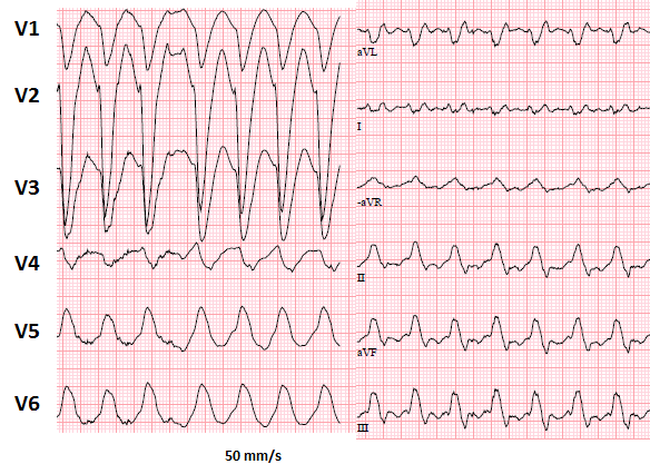 14 Vad visar EKG? 1. Kammartakykardi x. Förmaksfladder 2. Förmaksflimmer Hur bör denna patient behandlas akut? 1. Intravenös betablockad för att reglera ned frekvensen och få rytmen att konvertera till sinusrytm.