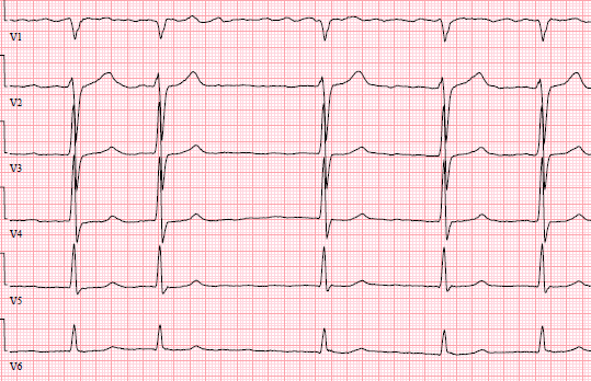 16 Vad visar EKG för