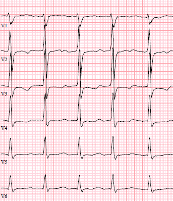 8 Vad visar EKG? 1. Förmaksfladder x. Förmaksflimmer 2. Annan supraventrikulär rytm Hur skall patienten behandlas för sin höga kammarfrekvens? 1. Ökning av atacand x.