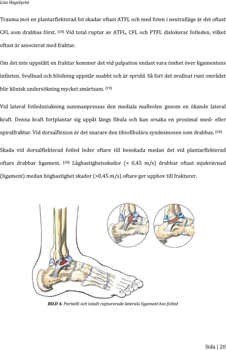 Om det inte uppstått en fraktur kommer det vid palpation endast varaa ömhet över ligamentens infästen. Svullnad och blödning uppstår snabbt och är spridd.