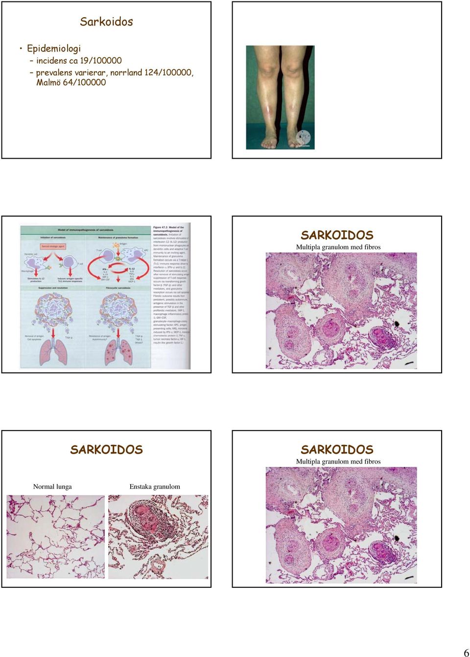 SARKOIDOS Multipla granulom med fibros SARKOIDOS
