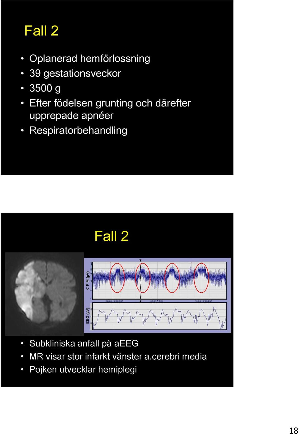 Respiratorbehandling Fall 2 Subkliniska anfall på aeeg MR