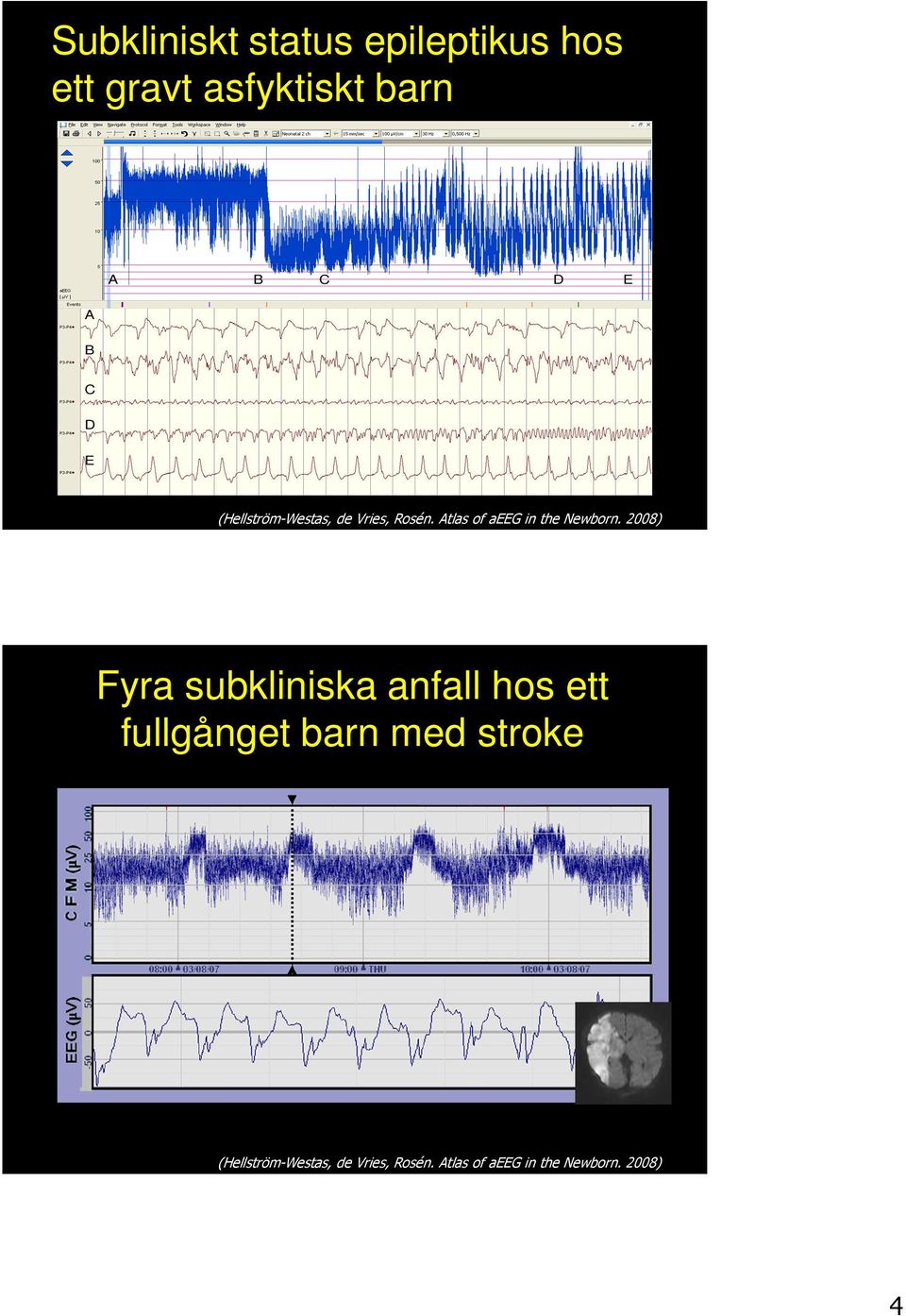 Atlas of aeeg in the Newborn.