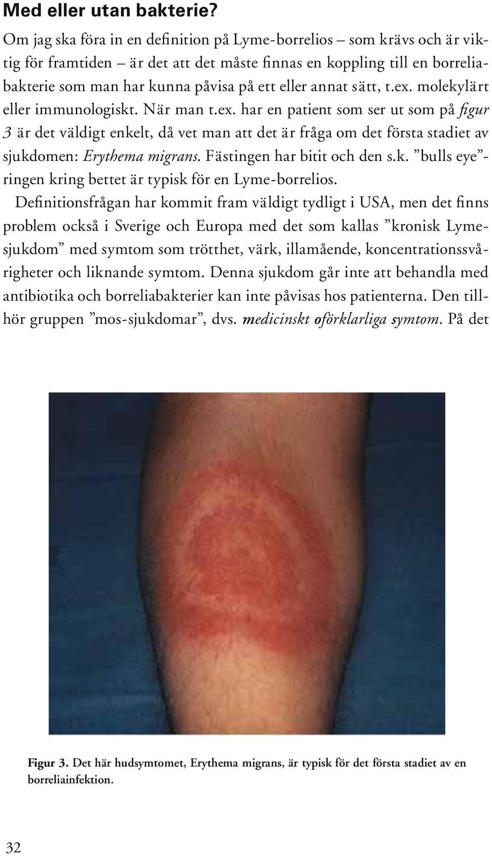 sätt, t.ex. molekylärt eller immunologiskt. När man t.ex. har en patient som ser ut som på fi g u r 3 är det väldigt enkelt, då vet man att det är fråga om det första stadiet av sjukdomen: Erythema migrans.