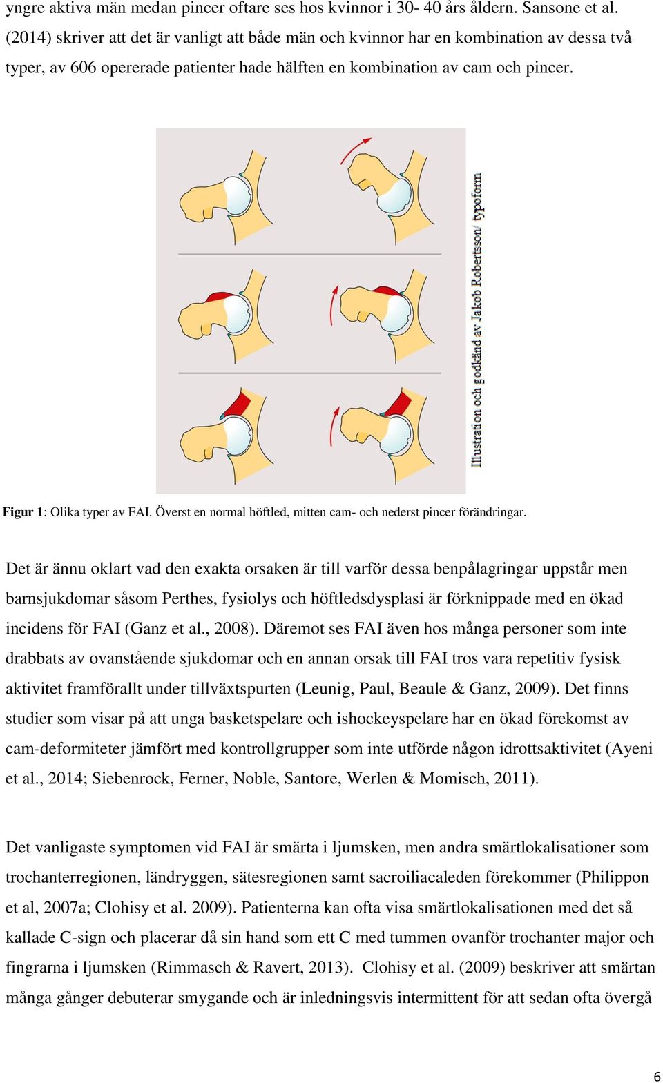 Överst en normal höftled, mitten cam- och nederst pincer förändringar.