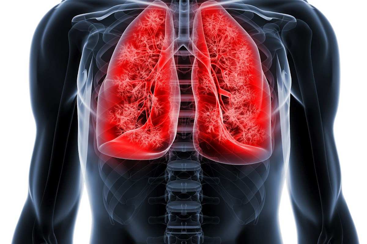 Respiratorisk bronkiolit-associerad interstitiell sjukdom (RB- ILD) Akut interstitiell pneumoni (AIP) Icke-specifik