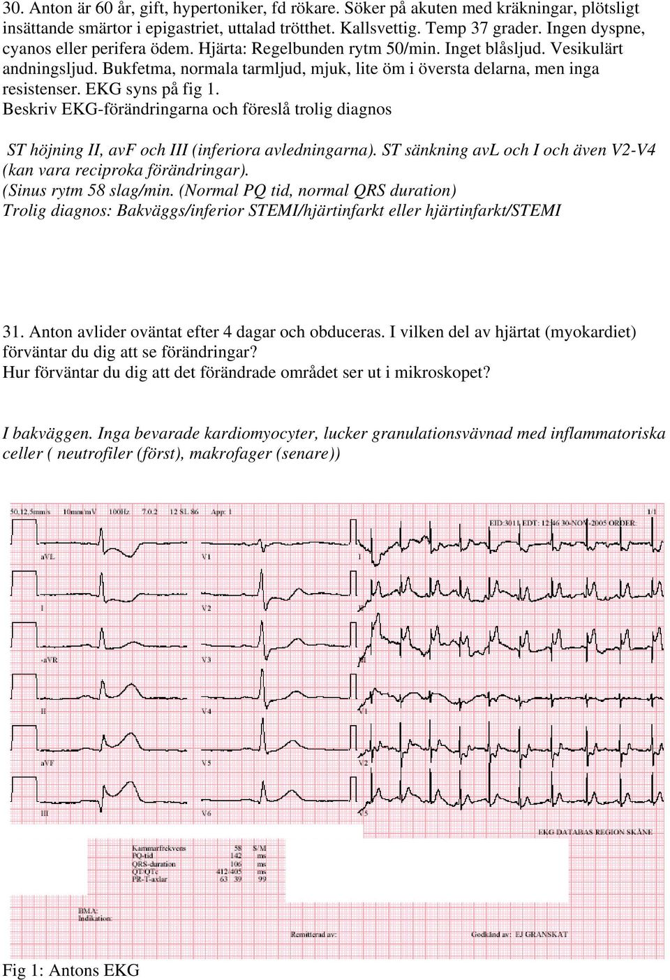 EKG syns på fig 1. Beskriv EKG-förändringarna och föreslå trolig diagnos ST höjning II, avf och III (inferiora avledningarna). ST sänkning avl och I och även V2-V4 (kan vara reciproka förändringar).
