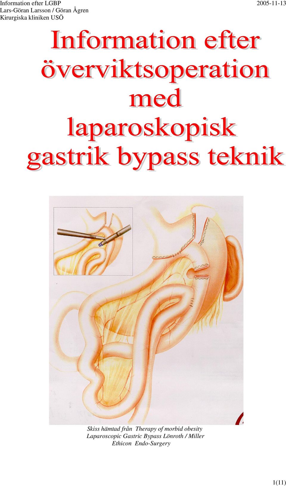 Gastric Bypass Lönroth /
