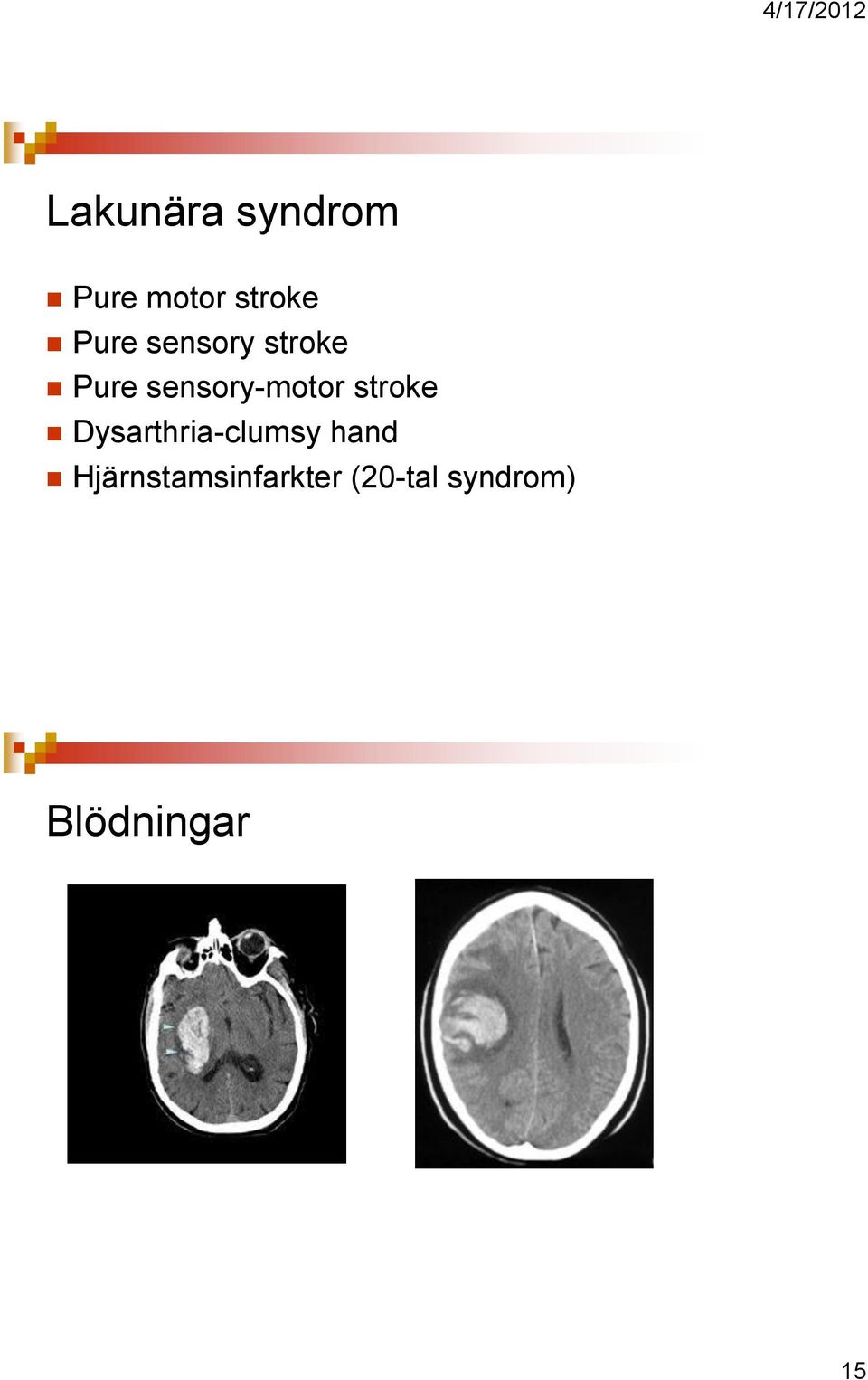 stroke Dysarthria-clumsy hand