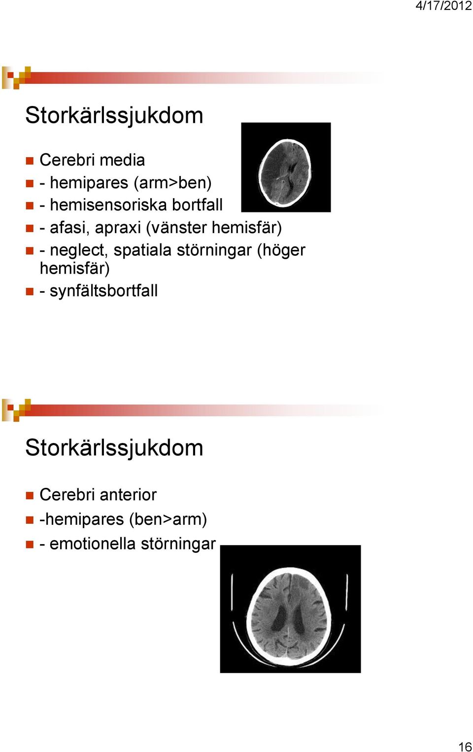 neglect, spatiala störningar (höger hemisfär) - synfältsbortfall