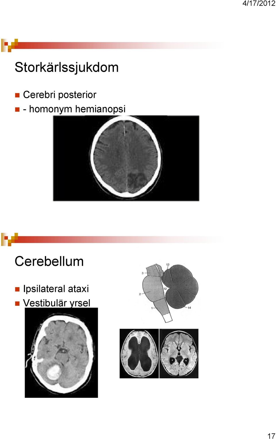 hemianopsi Cerebellum