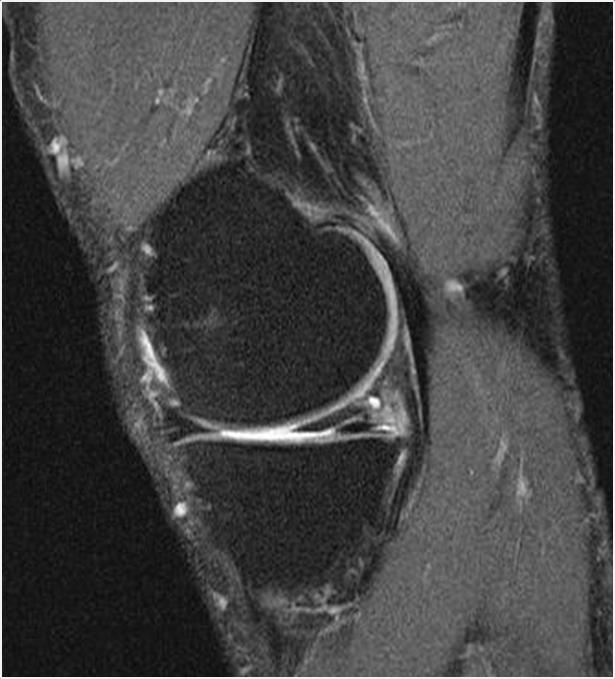 Förekomst av menisk skada (förändringar) knees from general