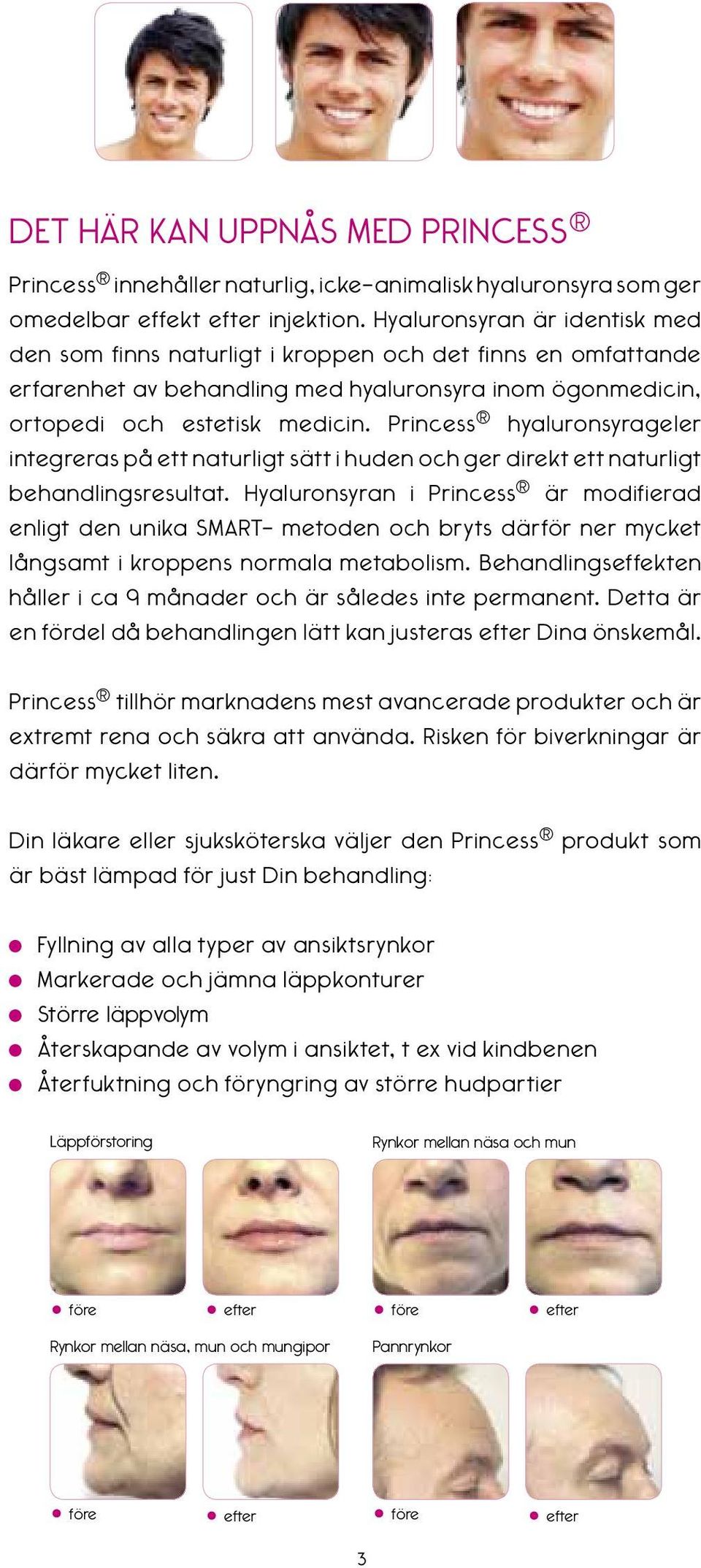 Princess hyaluronsyrageler integreras på ett naturligt sätt i huden och ger direkt ett naturligt behandlingsresultat.