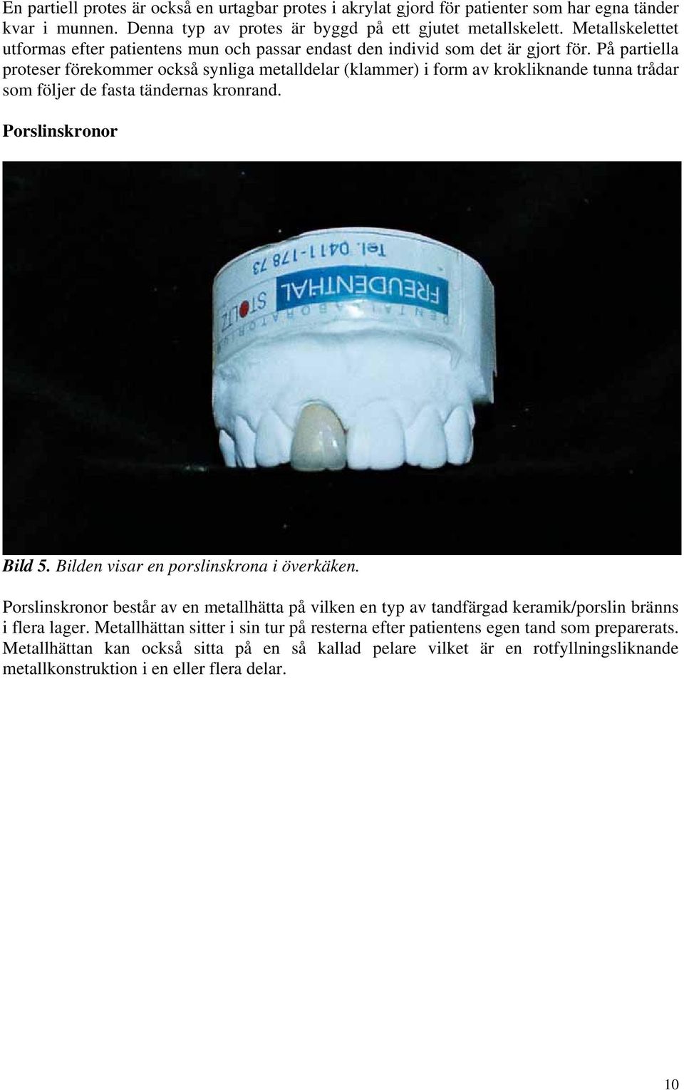 På partiella proteser förekommer också synliga metalldelar (klammer) i form av krokliknande tunna trådar som följer de fasta tändernas kronrand. Porslinskronor Bild 5.