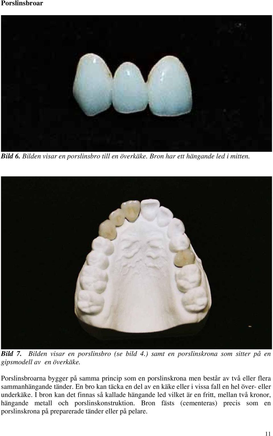 Porslinsbroarna bygger på samma princip som en porslinskrona men består av två eller flera sammanhängande tänder.