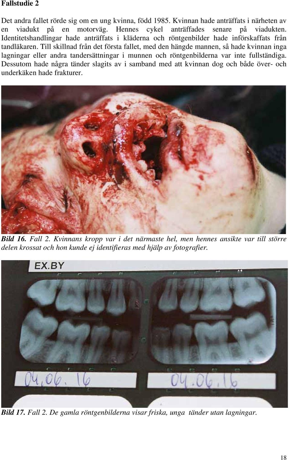 Till skillnad från det första fallet, med den hängde mannen, så hade kvinnan inga lagningar eller andra tandersättningar i munnen och röntgenbilderna var inte fullständiga.