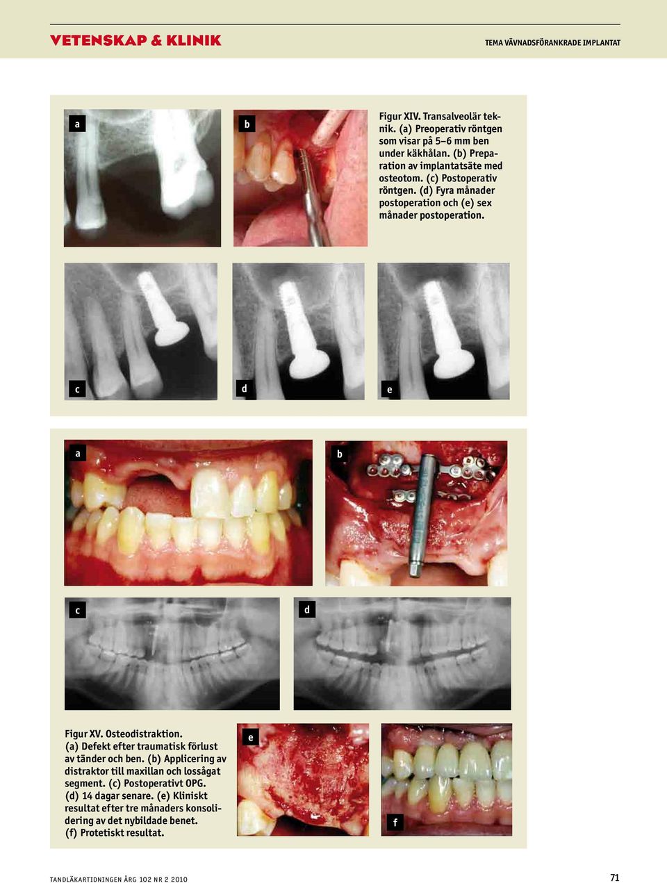 Osteoistrktion. () Defekt efter trumtisk förlust v täner oh en. () Appliering v istrktor till mxilln oh lossågt segment.