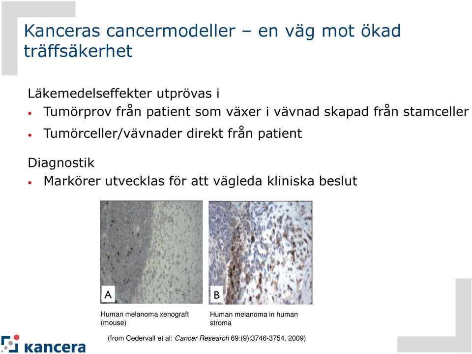 patient Diagnostik Markörer utvecklas för att vägleda kliniska beslut Human melanoma xenograft