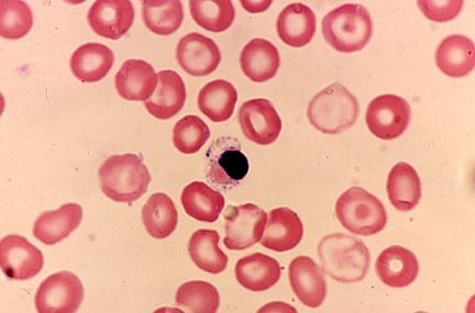 Thalassemi Major Klinisk manifestation Microcytär anemi Ineffektiv erytropoes
