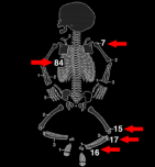 Oro för barnmisshandel Vad gav dig oro för misshandel? 1. Revbensfrakturer 2. Metafysfrakturer femur, tibia och humerus 3. Corner fractures 4. Fraktur på femur hos icke gångare 5. Obevittnat trauma 6.