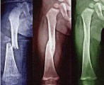 Barnortopedi - Barnskelett och deformitet Richard Marsell MD, PhD Barnortopeden Akademiska barnsjukhuset Som barnortoped konfronteras man med en hel del ovanliga syndrom och åkommor Disposition Vi