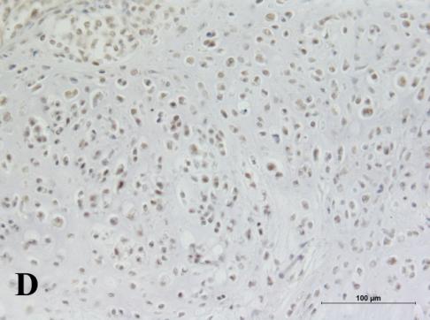 Figur 4: Infärgning av progesteronreceptorer (PR) med immunohistokemi. Som positivt infärgad cell räknades en cell vars cellkärna färgats in med DAB för PR.