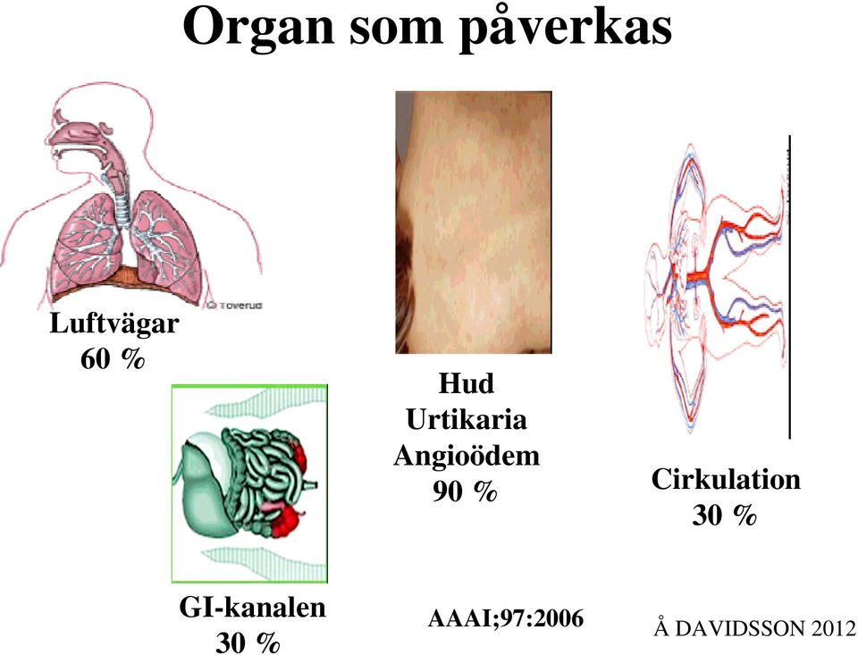 Urtikaria Angioödem 90 %