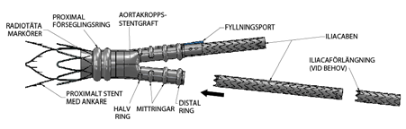 1. Produktbeskrivning TriVascular Ovation ix abdominellt stentgraftsystem är en endovaskulär anordning som via en lågprofilkateter sätts in för att behandla abdominella aortaaneurysm (AAA).