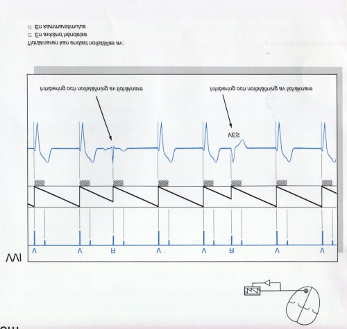 Avkänd kammare (A, V, D) Funktion (O=ingen, T=triggad, I=inhiberad) Exempel: VOO Stimulerar kammaren, går hela tiden med fast frekvens VVI Stimulerar kammaren, inhiberas av spontanslag DDD Stimulerar