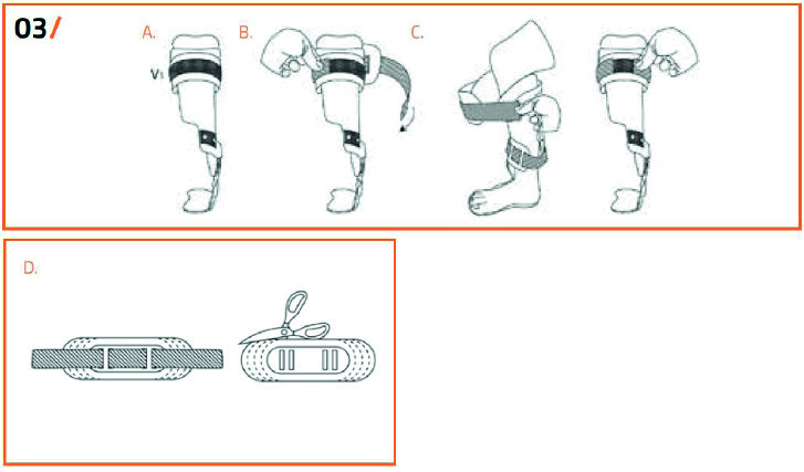 LH (Lateral Hinge) MH (Medial Hinge) 5 STEG03/SÄTTA FAST DET ÖVRE BANDET A. Det finns ett brett kardborrband (V1) på övre delen av skenbensskalets utsida på STEP-ON 100 LH och STEP-ON 100 MH AFO. B. Fäst ena änden av bandet på ena sidan av kardborrfästet (V1) så att halva längden av detta täcks.