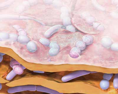 En mikrobiell barriär designad för att minska risken för kontaminering av operationsområdet från hudfloran.