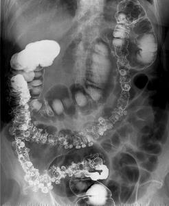 Enkelkontrast enkelkontrast - esophagus us fyllningsdefekt (pilar) cancer i mitten av esophagus Bildkälla: http://www.medcyclopaedia.