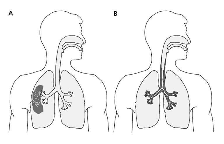 exacerbation av kronisk bronkit/kol är inflammationen istället lokaliserad till bronkerna och bronkträdet (Figur 2B).