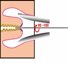 Figur 7. Cervex-Brush Borstens spröt anpassar sig efter de flesta livmodertappar och fångar både exooch endocervikala celler samtidigt.