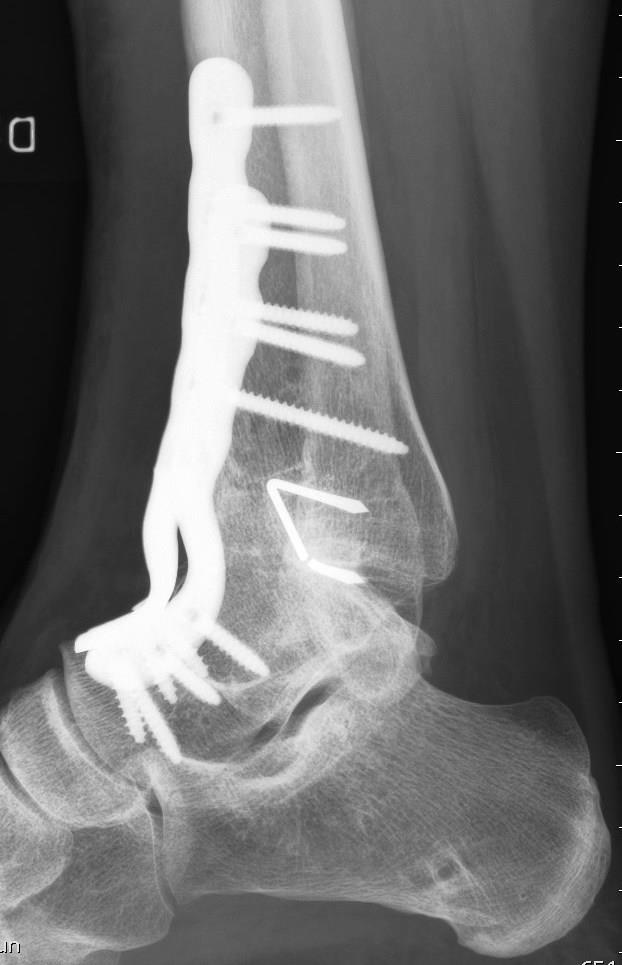 Figur 12. Röntgenbild av fotledsartrodes utförd med hjälp av retrograd märgspik.