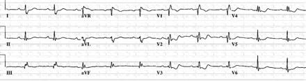 Ebsteins anomali EKG EKG är onormalt hos de flesta patienter med Ebstein s anomali - Höga och breda P-vågor till följd av höger förmaks förstoring - Komplett eller inkomplett RBBB - Låga
