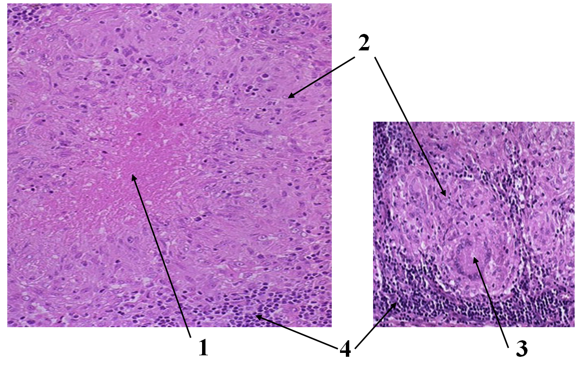 KOD: 25. Frågan gäller inflammation. a) Vilken inflammationstyp illustreras av dessa två mikroskopiska bilder?