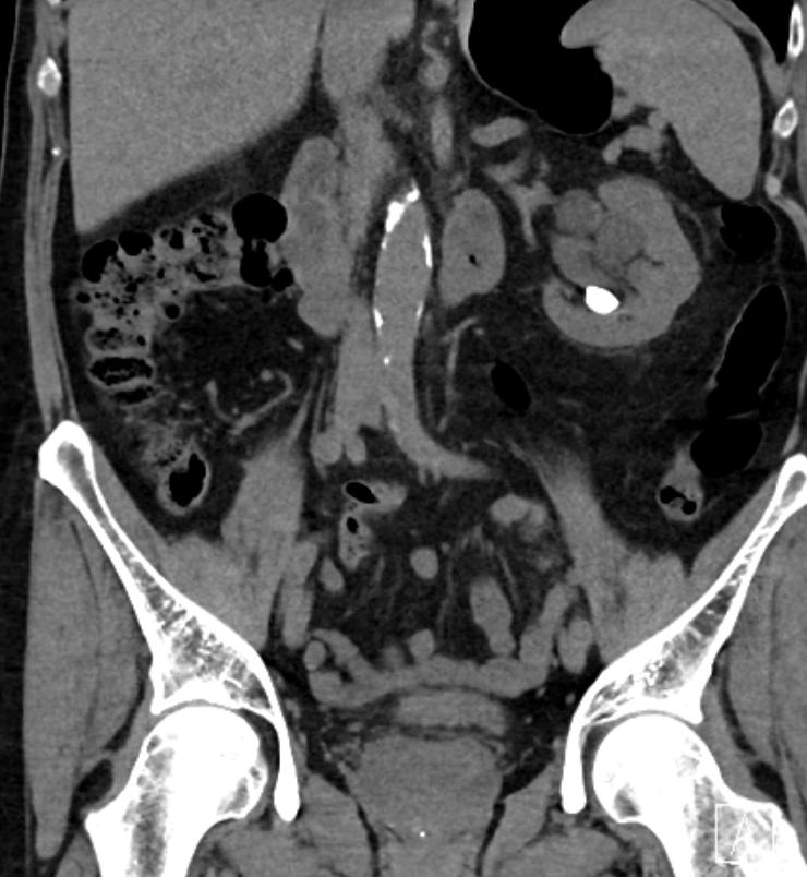 4:4 En patient med en vänstersidig njursten enligt bifogad CT-urografi, där bilden nedan är från första CT-serien. Stenen mäter 15 mm i diameter.