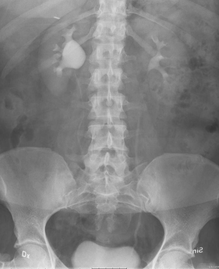 4:9 Du tjänstgör som urolog och har mottagning där en remisspatient dyker upp med följande anamnes och röntgenbild: 22-årig T8-student med episoder av högersidig måttlig flanksmärta med ett par