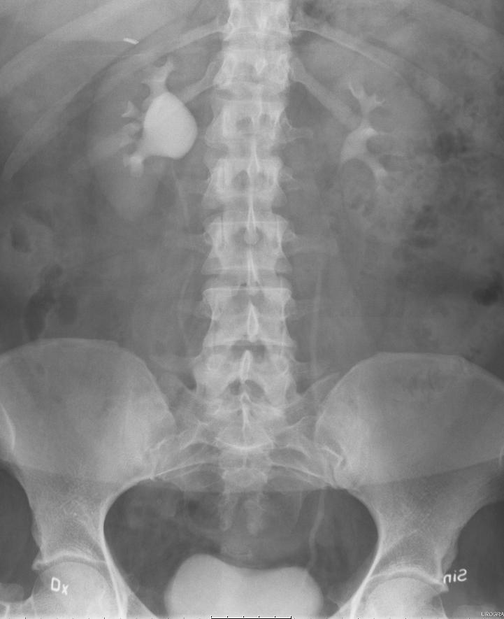 4:9 Du tjänstgör som urolog och har mottagning där en remisspatient dyker upp med följande anamnes och röntgenbild: 22-årig T8-student med episoder av högersidig måttlig flanksmärta med ett par