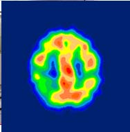 CT Computed Tomography (skiktröntgen) Elektrontätheten i kroppen i 2 och 3D Michael Ljungberg/Medical JoniserandeRadiation Physics/Clinical Sciences Lund/Lund University/Sweden Icke-joniserande 13