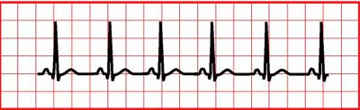 ambulansen. Status: Fri luftväg, Lungor: Vänstersidig rassel, AF 35, Sat89%. Cor: RR, frekv. 41/min, BT: Saturationen stiger till 99% på 6 liter syrgas på mask.