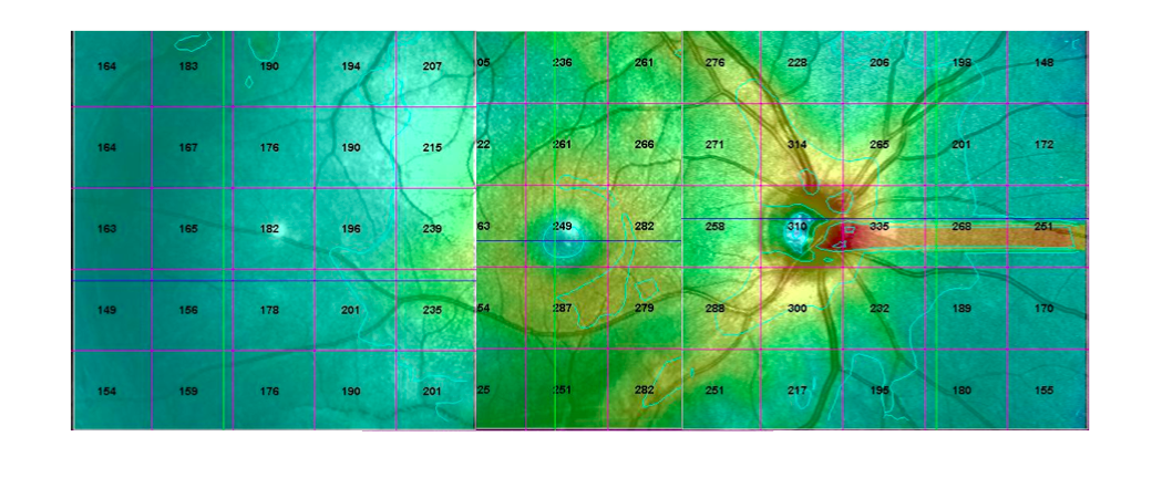 3.4 Sammanställning och analys av data För varje försöksperson erhölls tre bilder från olika delar av retina, se figur 7. Varje bild delades in i ett rutmönster om 5x5 rutor.